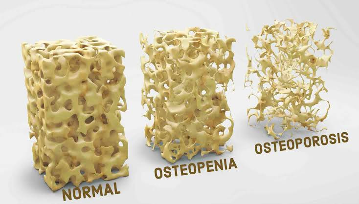 osteoporosis_fases.jpg